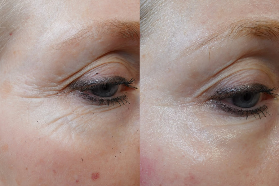 Anti-aging microneedling behandeling