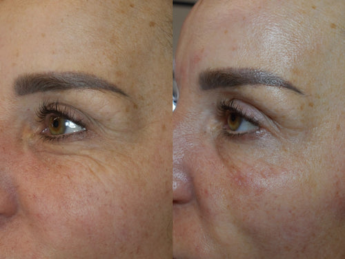Anti-aging microneedling, resultaat